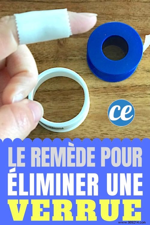 Proven Home Remedy: Eliminate Stubborn Warts with the Band-Aid Occlusion Method