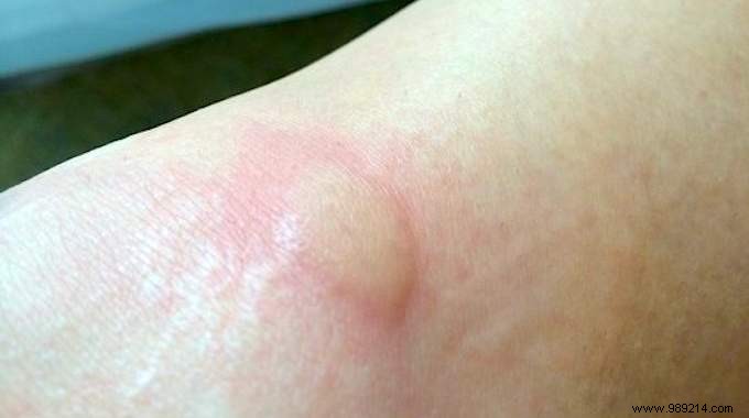 Instant Mosquito Bite Relief: Fresh Aloe Vera s Proven Natural Remedy