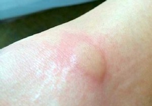 Instant Mosquito Bite Relief: Fresh Aloe Vera s Proven Natural Remedy