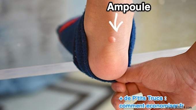 Prevent Foot Blisters for Good: The Proven Lemon Juice Trick from Seasoned Hikers