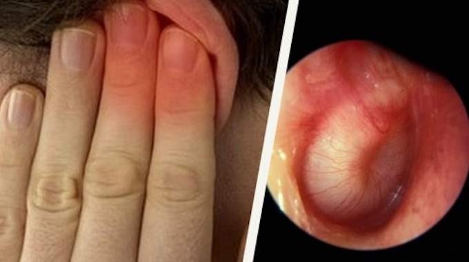 Prevent Swimmer s Ear Effectively: Grandma s Proven Vinegar-Alcohol Remedy