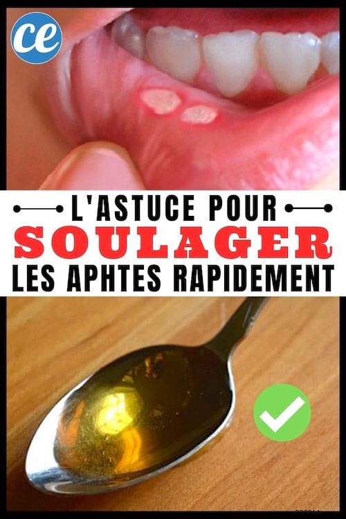 Heal Canker Sores Fast: Proven Honey Remedy for Quick Relief