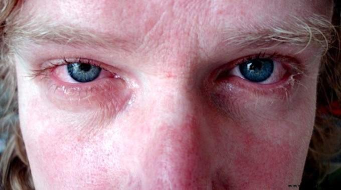 Hay Fever Relief: Discover This Proven Natural Clay Nasal Rinse