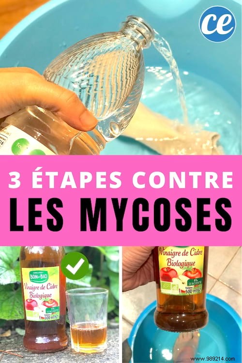 Eliminate Foot Fungus Naturally: 3 Proven Vinegar-Based Steps