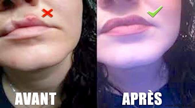 Stop Cold Sores on Your Lips Fast: The Apple Cider Vinegar Remedy