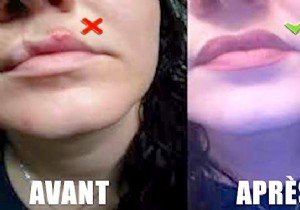 Stop Cold Sores on Your Lips Fast: The Apple Cider Vinegar Remedy