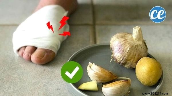 Relieve Gout Attacks Naturally: Simple Garlic Poultice Remedy