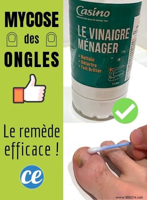Simple White Vinegar Remedy for Nail Fungus: A Proven Natural Treatment
