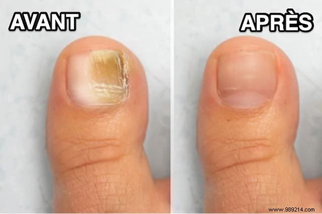 Simple White Vinegar Remedy for Nail Fungus: A Proven Natural Treatment