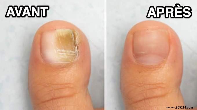 Simple White Vinegar Remedy for Nail Fungus: A Proven Natural Treatment