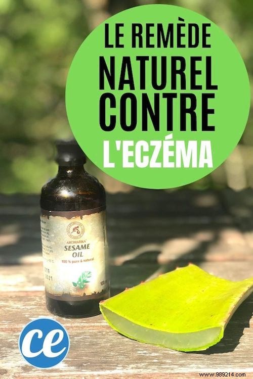 Proven Natural Remedy for Hand Eczema: Aloe Vera and Sesame Oil