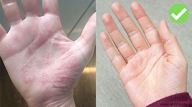 Proven Natural Remedy for Hand Eczema: Aloe Vera and Sesame Oil