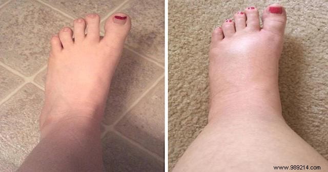 Swollen Feet from Summer Heat? This Proven Magnesium Chloride Foot Soak Provides Fast Relief