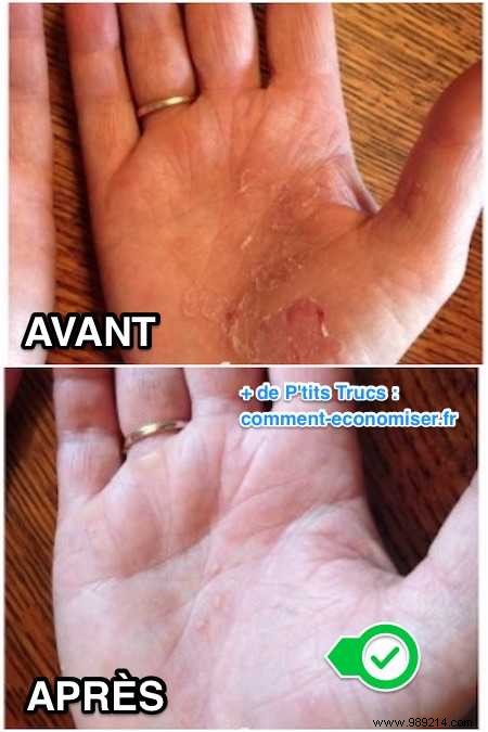 Grandma s Proven Natural Remedy: Fast Relief for Psoriasis Flare-Ups