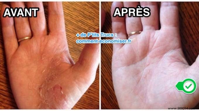 Grandma s Proven Natural Remedy: Fast Relief for Psoriasis Flare-Ups