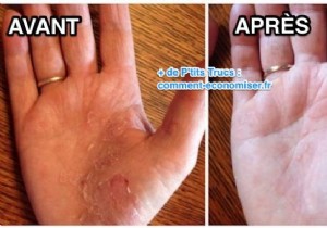 Grandma s Proven Natural Remedy: Fast Relief for Psoriasis Flare-Ups