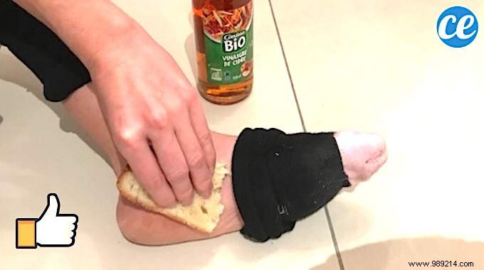 Grandma s Proven Remedy: Banish Foot Corns and Calluses Overnight Naturally