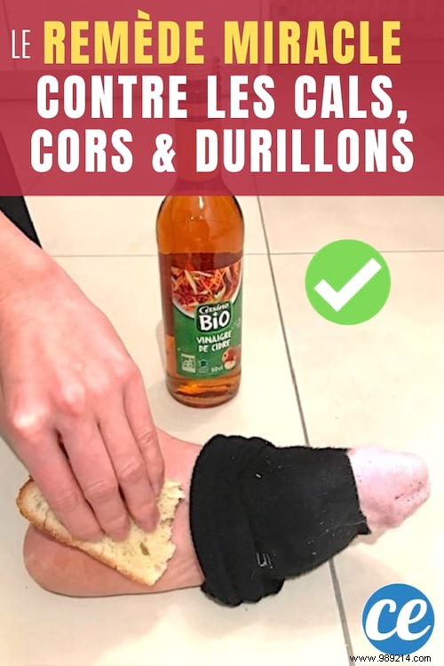 Grandma s Proven Remedy: Banish Foot Corns and Calluses Overnight Naturally