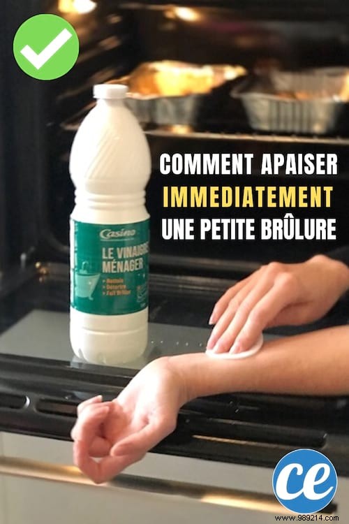 Soothe Minor Burns Fast: White Vinegar s Proven Relief Method