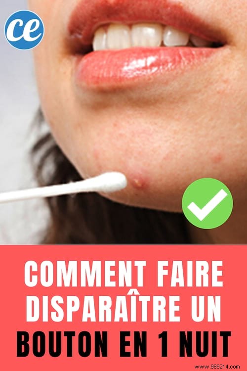 How to Banish a Pimple Overnight: A Trusted Natural Vinegar Remedy