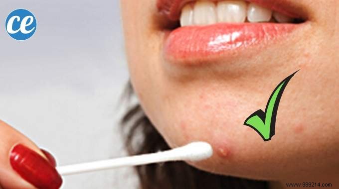 How to Banish a Pimple Overnight: A Trusted Natural Vinegar Remedy