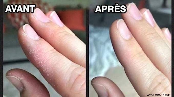 Heal Dry, Chapped Winter Hands Naturally with Olive Oil: A Proven Remedy