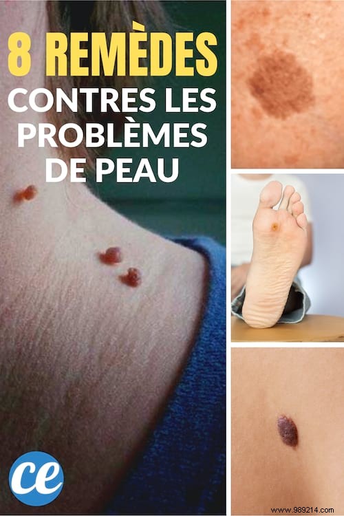 8 Proven Natural Remedies for Warts, Skin Tags, Blackheads, Moles, and Age Spots