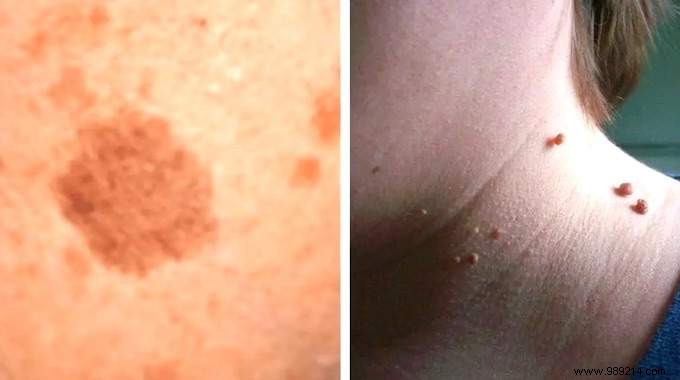 8 Proven Natural Remedies for Warts, Skin Tags, Blackheads, Moles, and Age Spots