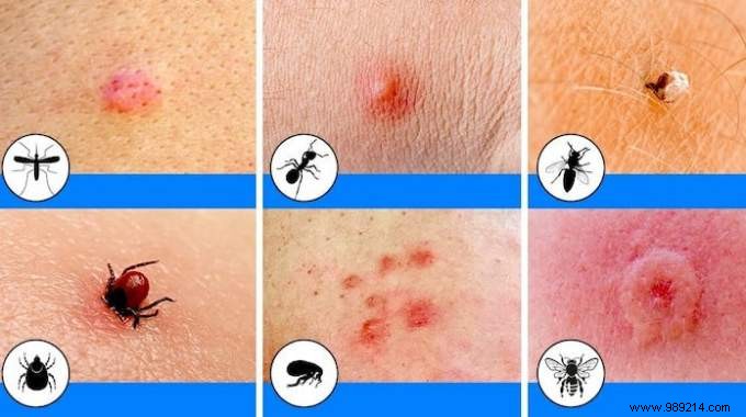 How to Identify Insect Bites: Simple Photo Guide to Common Culprits