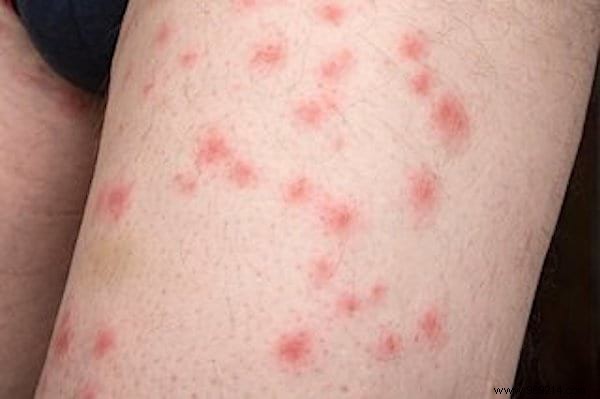 How to Identify Insect Bites: Simple Photo Guide to Common Culprits