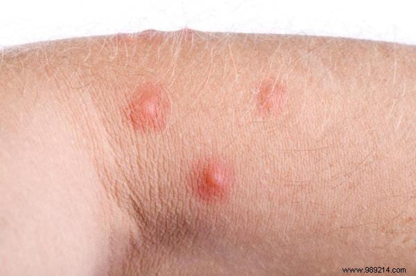 How to Identify Insect Bites: Simple Photo Guide to Common Culprits