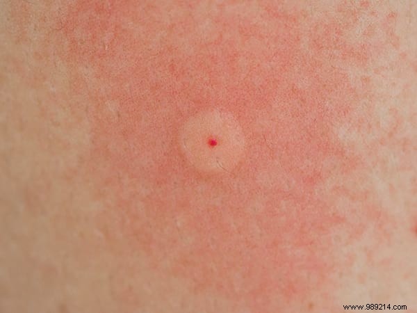How to Identify Insect Bites: Simple Photo Guide to Common Culprits