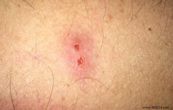 How to Identify Insect Bites: Simple Photo Guide to Common Culprits