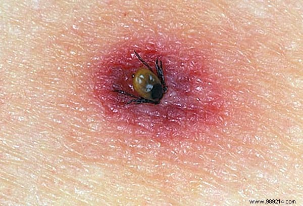 How to Identify Insect Bites: Simple Photo Guide to Common Culprits