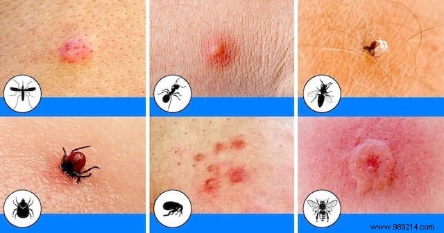 How to Identify Insect Bites: Simple Photo Guide to Common Culprits