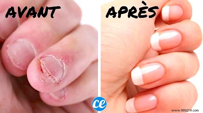 6 Proven Tips to Stop Nail Biting for Good: Backed by Experts