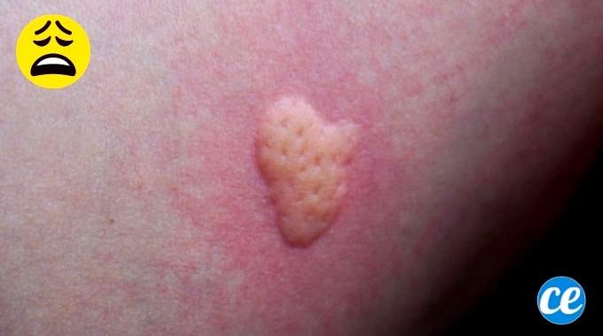 Relieve Mosquito Bite Itch Fast: Grandma s Baking Soda and Witch Hazel Paste Remedy