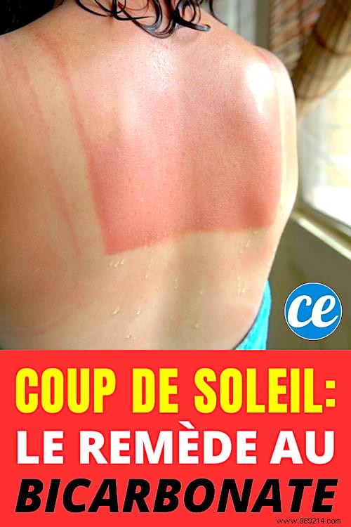 Soothe Sunburn Quickly: The Proven Baking Soda Compress Remedy