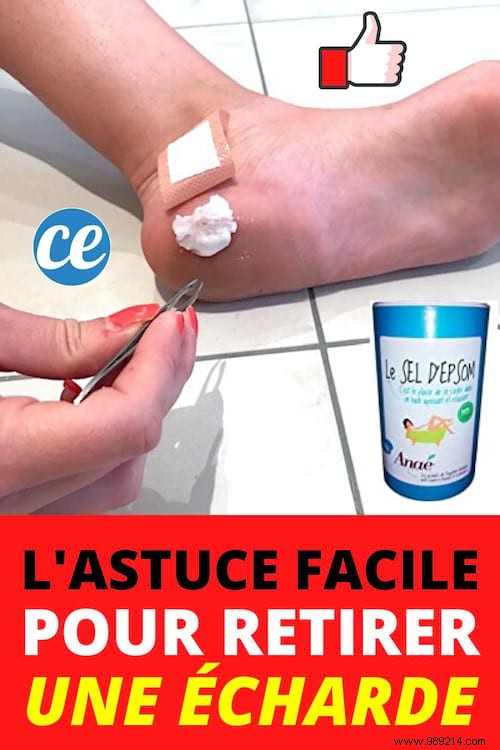 How to Painlessly Remove Deep Splinters: Proven Epsom Salt Remedy