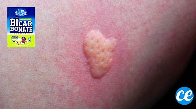 Soothe Mosquito Bites Fast: Baking Soda Paste Relief in Just 1 Minute