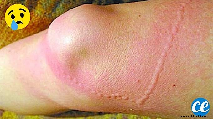 How to Instantly Relieve Jellyfish Sting Pain: Proven Vinegar Method