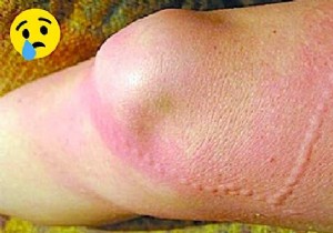 How to Instantly Relieve Jellyfish Sting Pain: Proven Vinegar Method