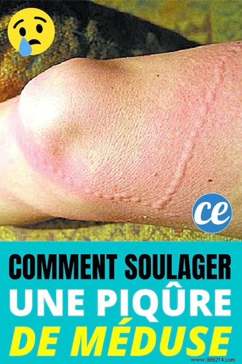 How to Instantly Relieve Jellyfish Sting Pain: Proven Vinegar Method