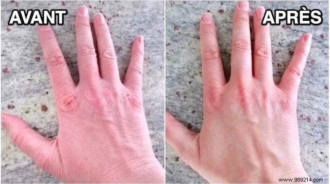 Heal Dry Hands from Hand Sanitizer with Shea Butter: A Proven Natural Remedy