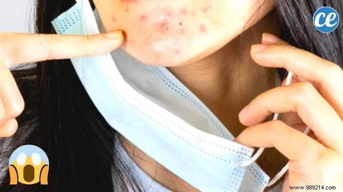 10 Dermatologist-Recommended Tips to Prevent Maskne and Keep Skin Clear