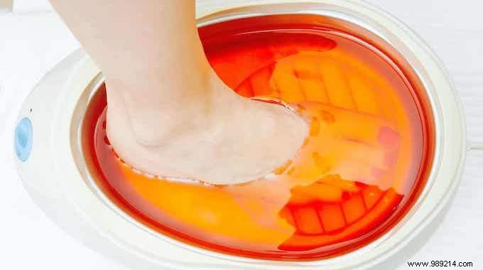 4 Proven Natural Vinegar Remedies for Varicose Veins, Corns, and Calluses