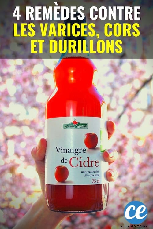 4 Proven Natural Vinegar Remedies for Varicose Veins, Corns, and Calluses