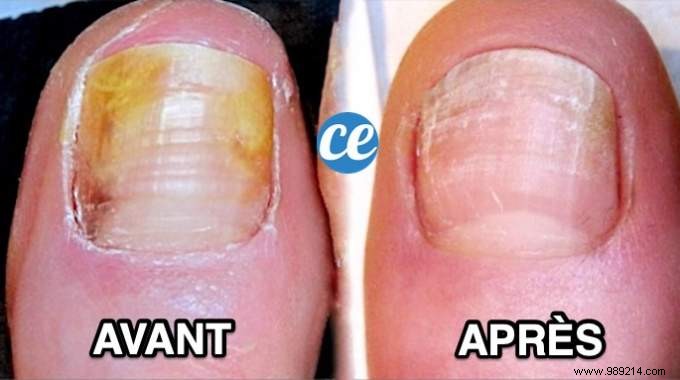How I Beat Nail Fungus with 5 Proven Natural Remedies