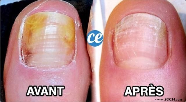 How I Beat Nail Fungus with 5 Proven Natural Remedies