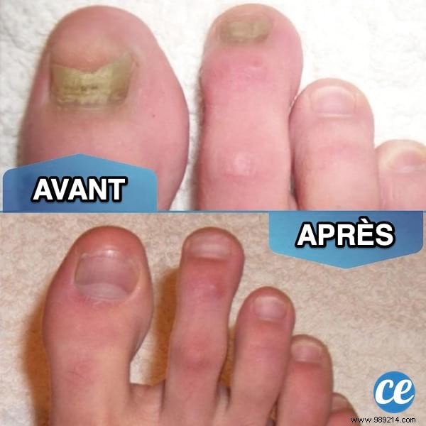 Effective Natural Remedy for Nail Fungus: 70° Alcohol Foot Bath